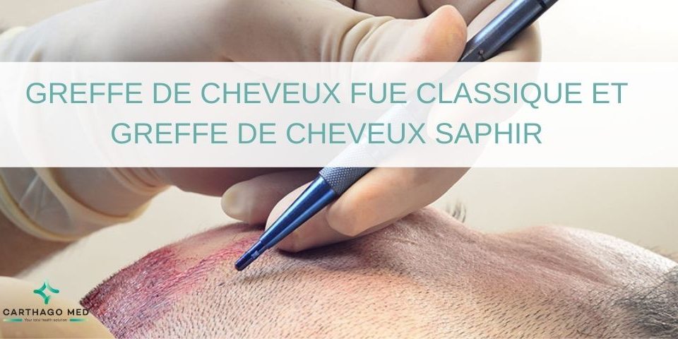 Greffe de cheveux Fue classique et saphir