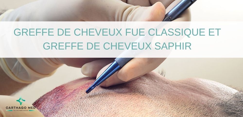 Greffe de cheveux Fue classique et saphir