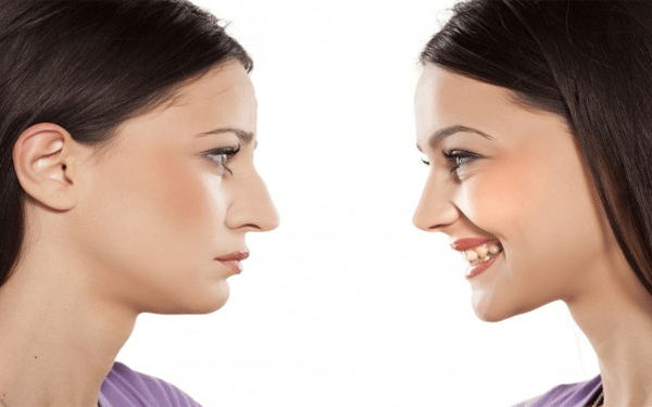 rhinoplastie-chirurgie-nez