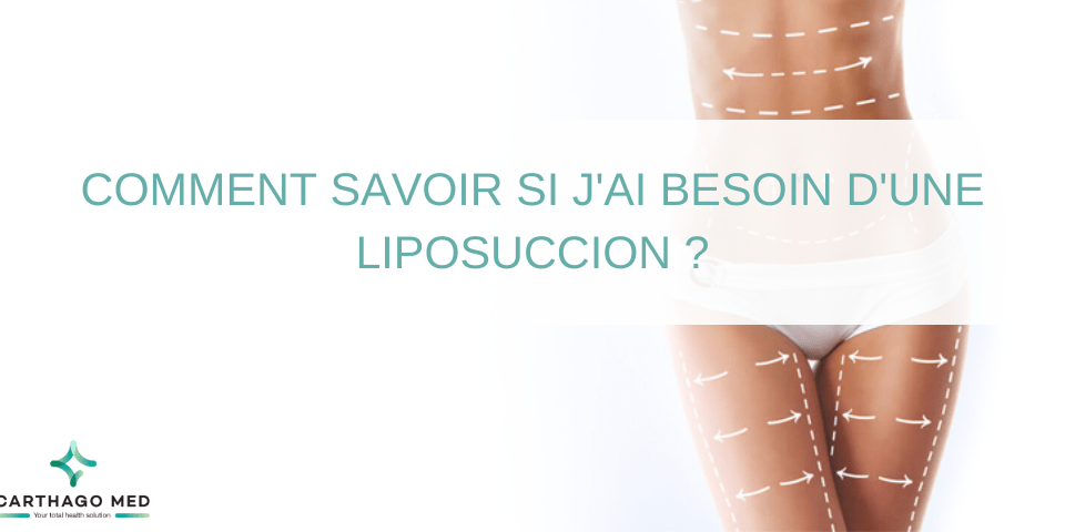 besoin savoir liposuccion