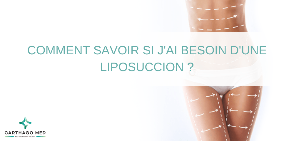 besoin savoir liposuccion