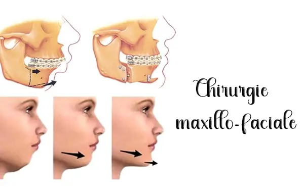 chirurgie maxillo-faciale