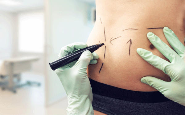 lipoaspiration-liposuccion