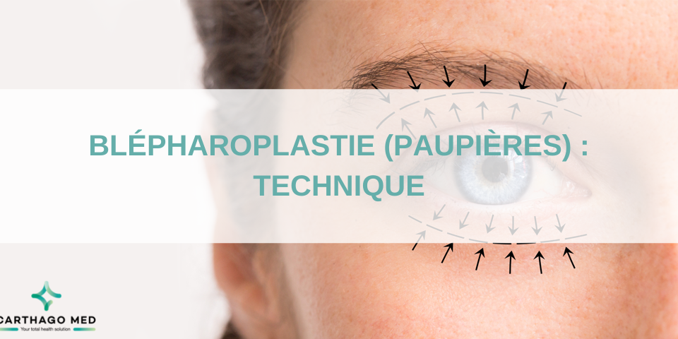 Blépharoplastie