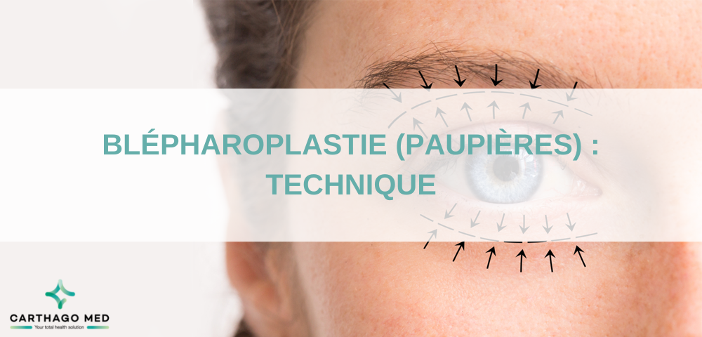 Blépharoplastie