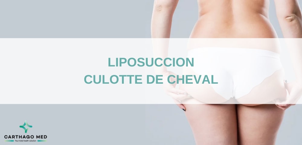 Liposuccion culotte de cheval