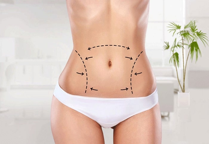 abdominoplastie