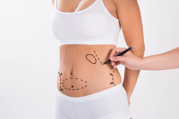 cas abdominoplastie