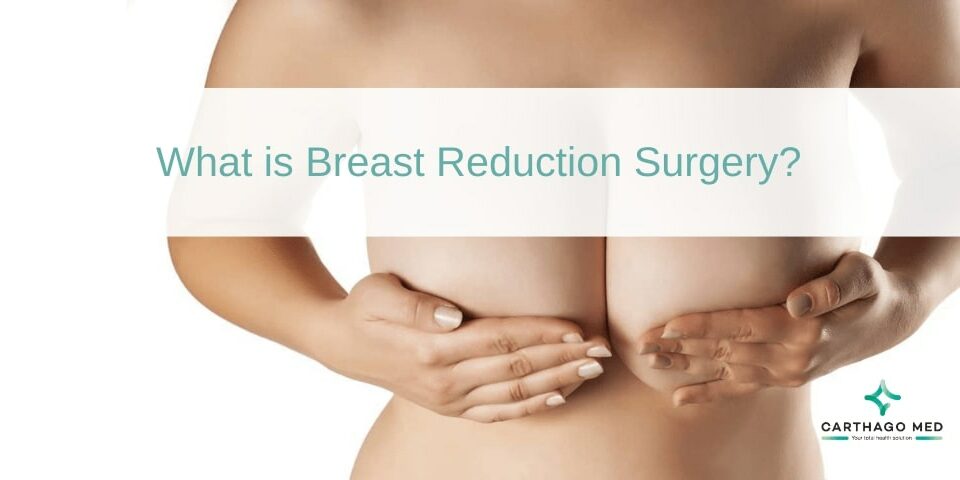 Breast reduction surgery