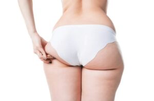 liposuccion culotte de cheval