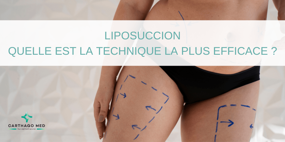 liposuccion : quelle technique efficace ?