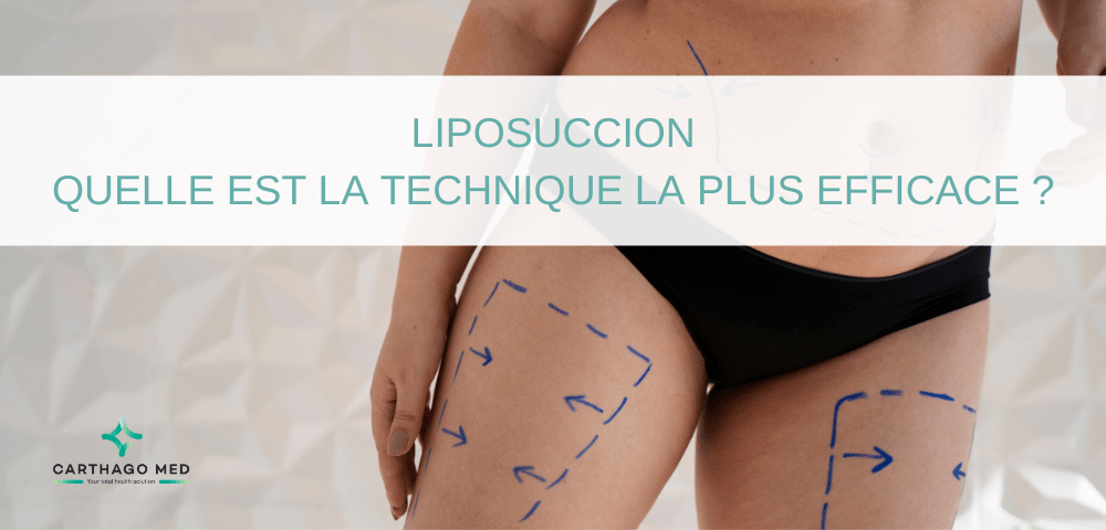 liposuccion : quelle technique efficace ?