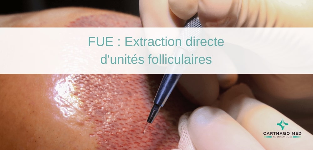 FUE Extraction directe d'unités folliculaires