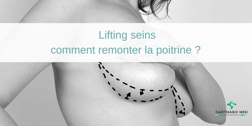 lifting seins : comment remonter la poitrine ?