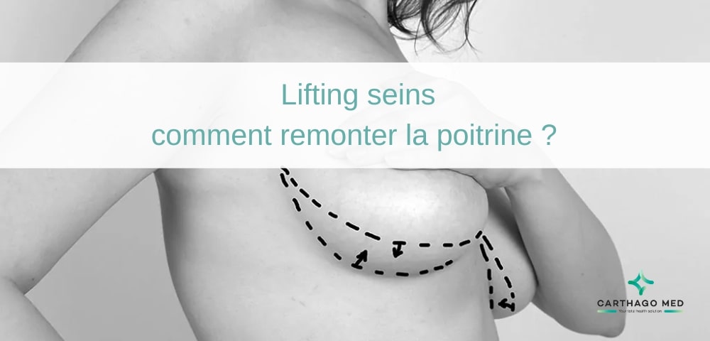 lifting seins : comment remonter la poitrine ?