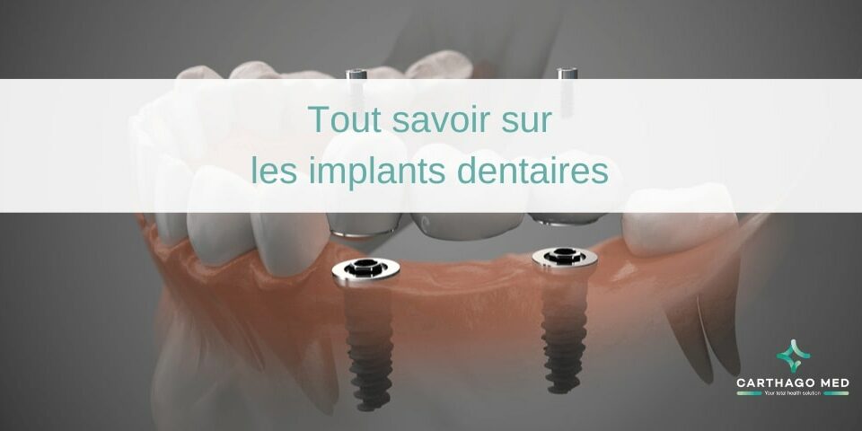 Tout savoir sur les implants denaitres