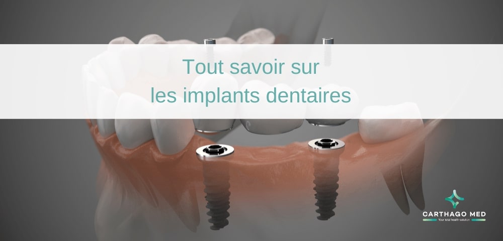 Tout savoir sur les implants denaitres