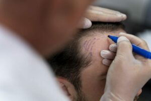 Le sport apres une greffe de cheveux: Quel est le meilleur moment