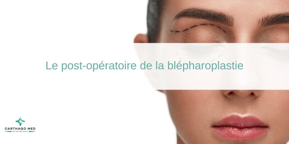 Le post-opératoire de la blépharoplastie