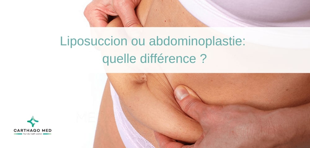 difference abdominoplastie liposuccion