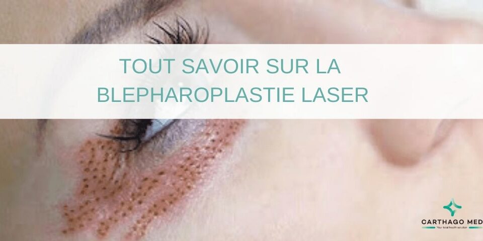 Tout savoir sur la blépharoplastie laser