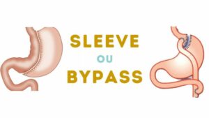 sleeve vs bypass