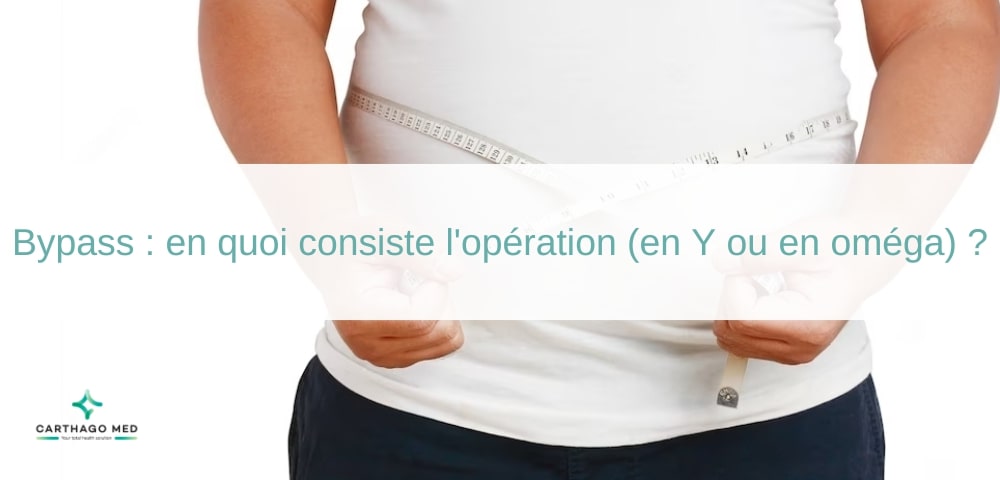 Bypass : en quoi consiste l'opération (en Y ou en oméga) ?