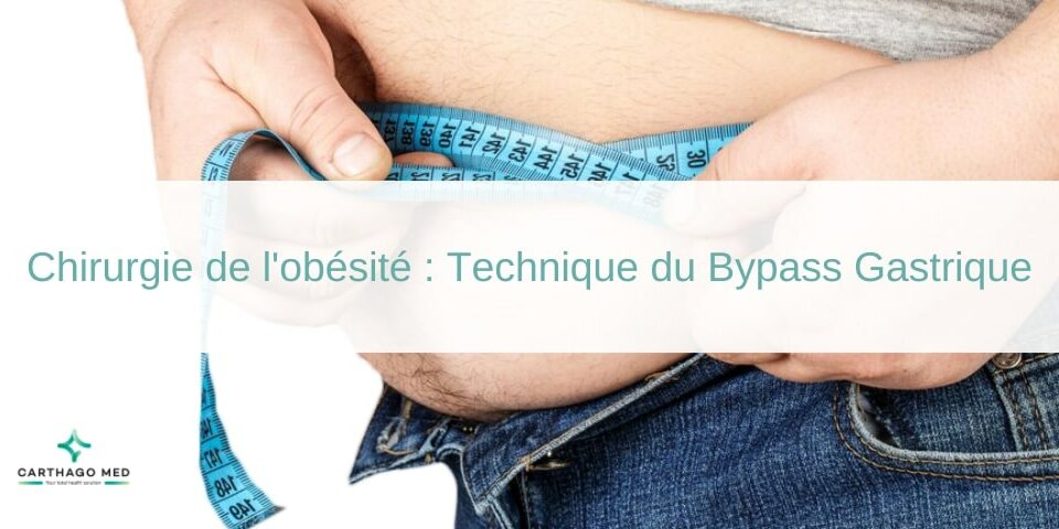 Chirurgie de l'obésité , technique du Bypass Gastrique