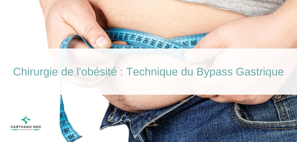 Chirurgie de l'obésité , technique du Bypass Gastrique