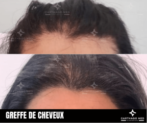 greffe cheveux avant apres 1