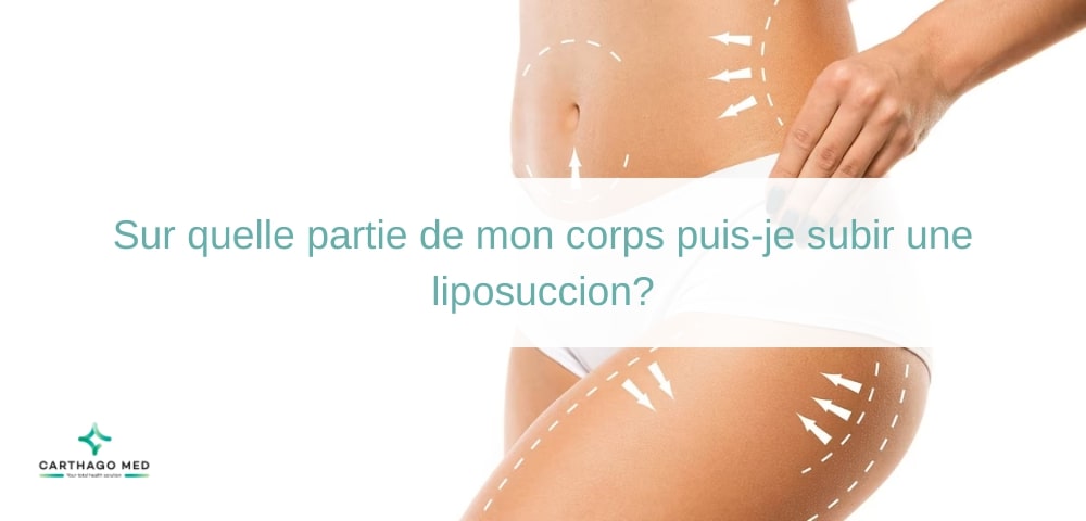 Sur quelle partie de mon corps puis-je subir une liposuccion?