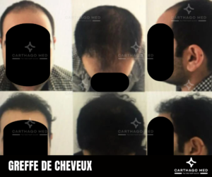 Greffe de cheveux carthagomed avant apres