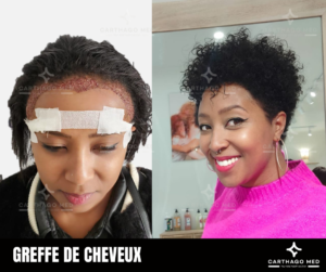 greffe de cheveux avant apres