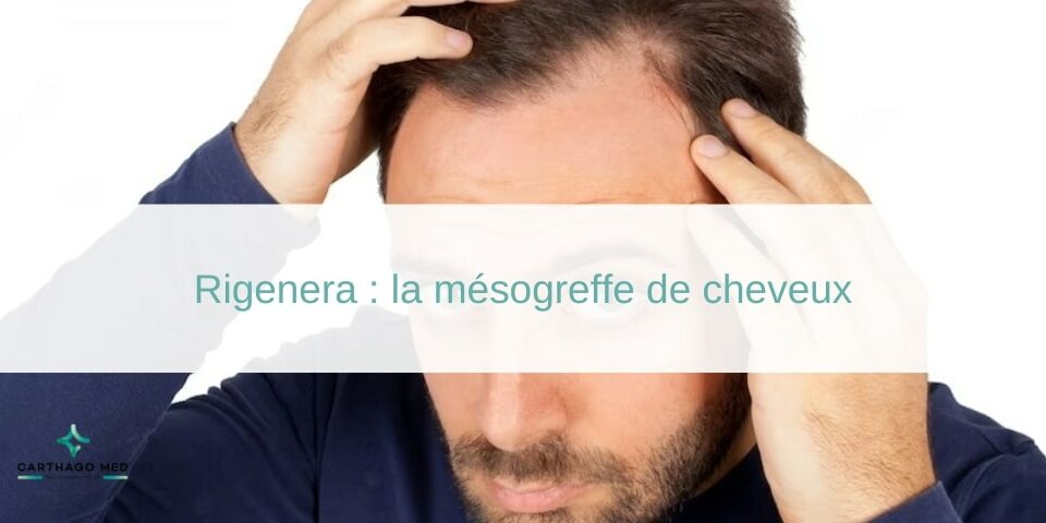 Rigenera : la mésogreffe de cheveux