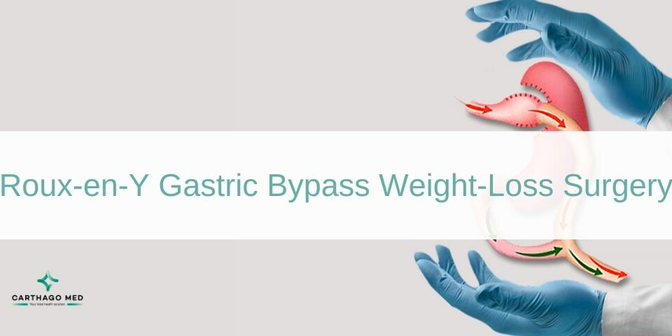 Gastric Bypass