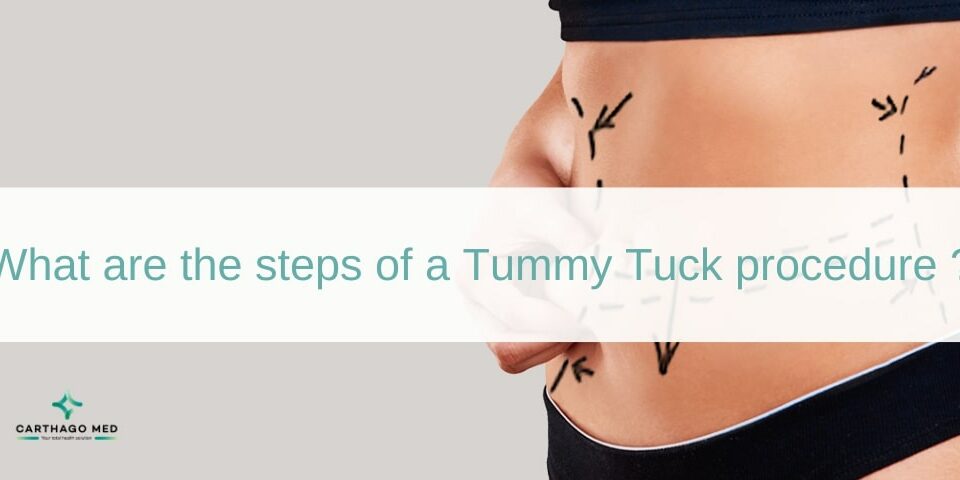 Tummy Tuck