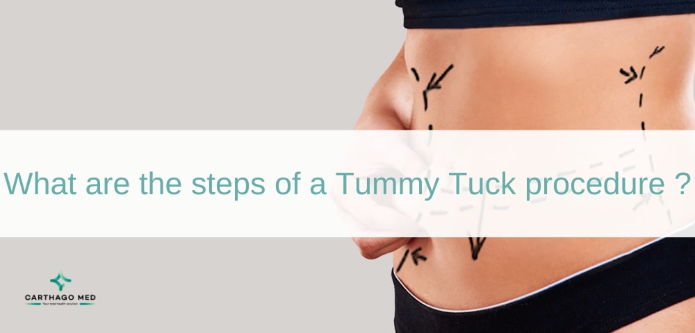 Tummy Tuck