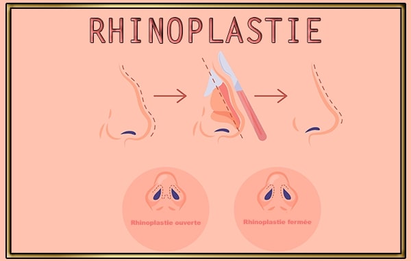 Rhinoplastie