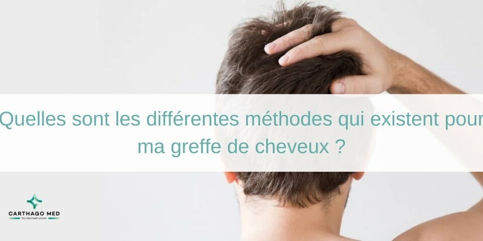 La greffe de cheveux