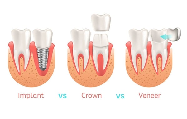 Dental Veneers