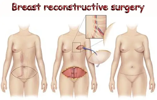 Reconstructive Surgery