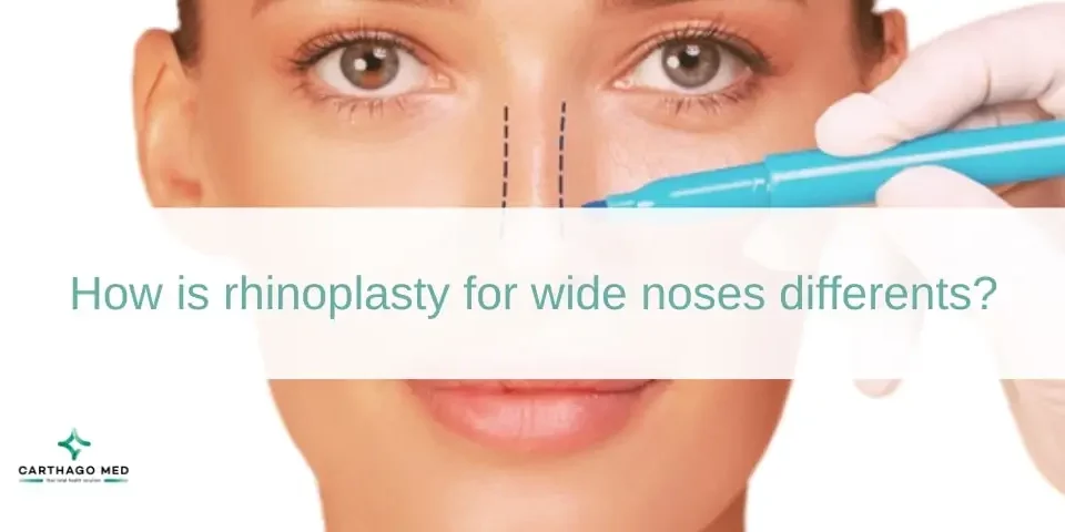 Rhinoplasty