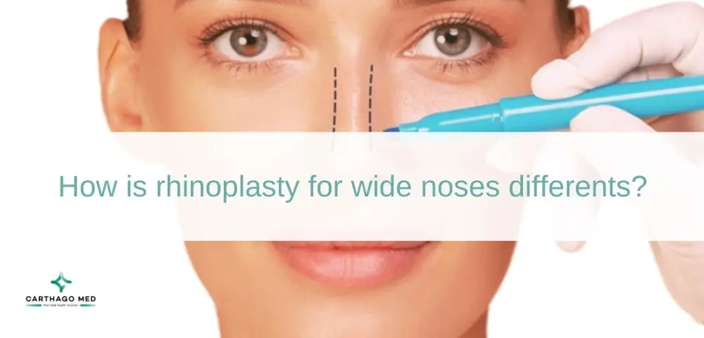 Rhinoplasty