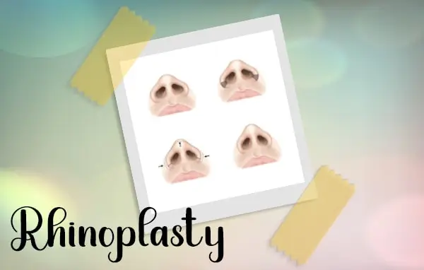 Rhinoplasty